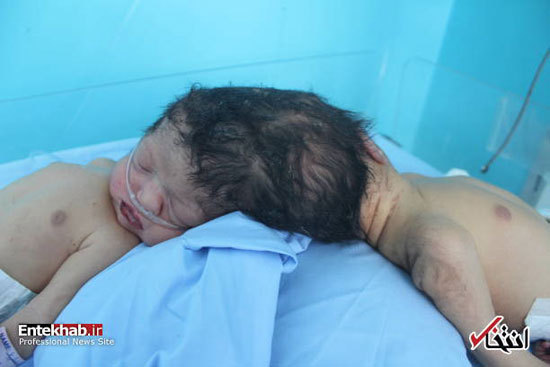 تولد دوقلو&zwnj;های به&zwnj; هم چسبیده در افغانستان +عکس