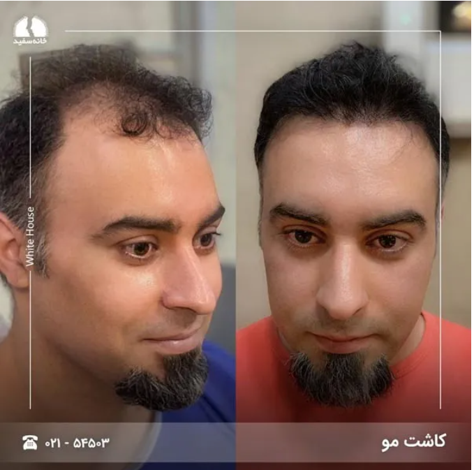 آشنایی با مراحل کاشت مو طبیعی